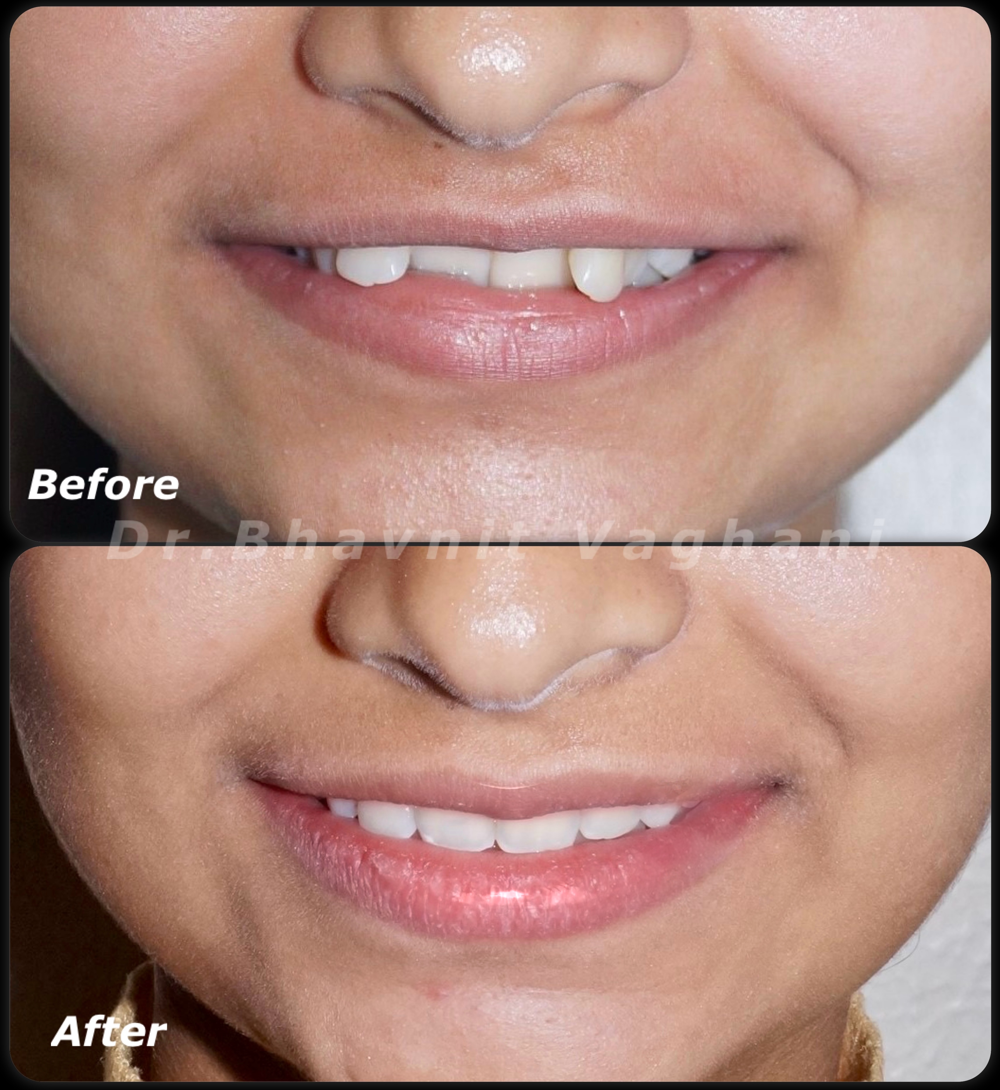 Severe Crowding Alignment - Before & After