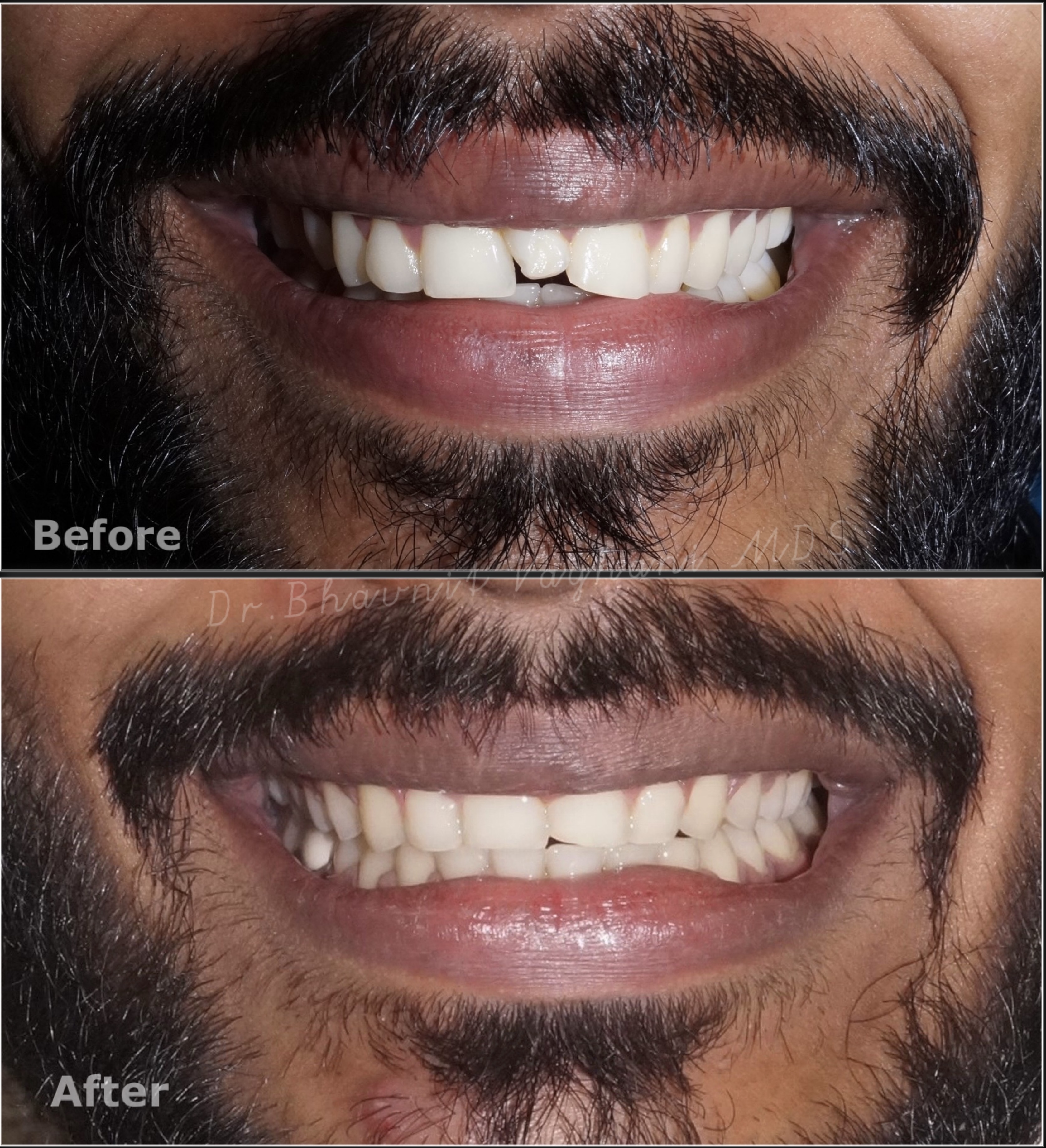 Extra Tooth & Alignment - Before & After