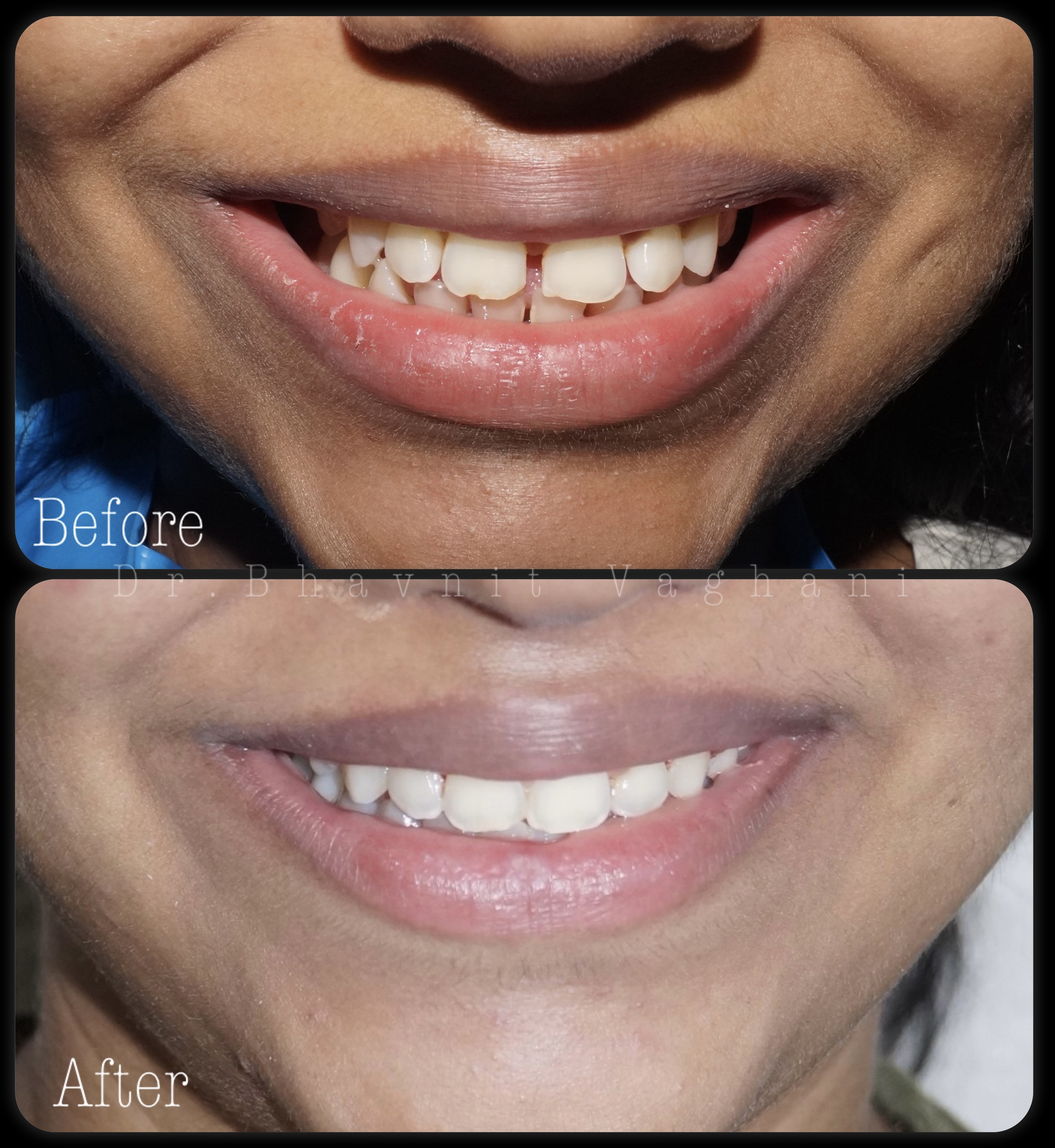 Midline Gap Closure - Before & After