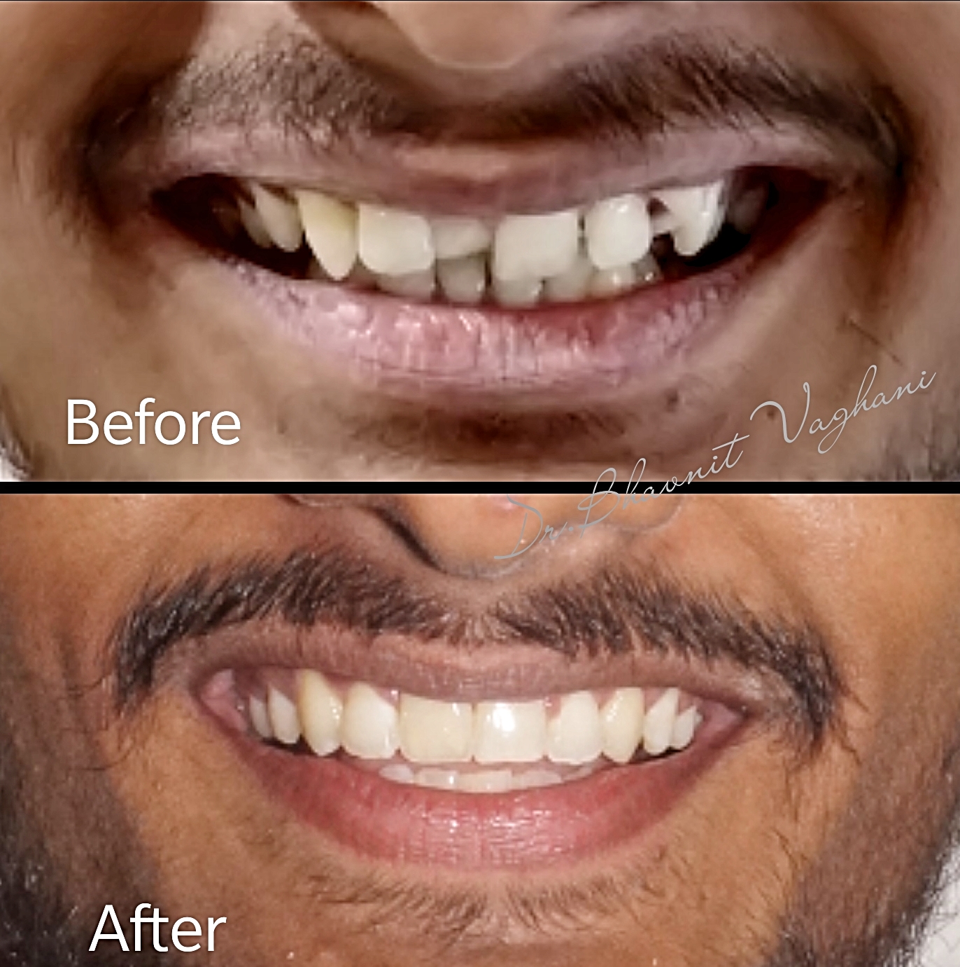 Impacted Teeth Traction - Before & After