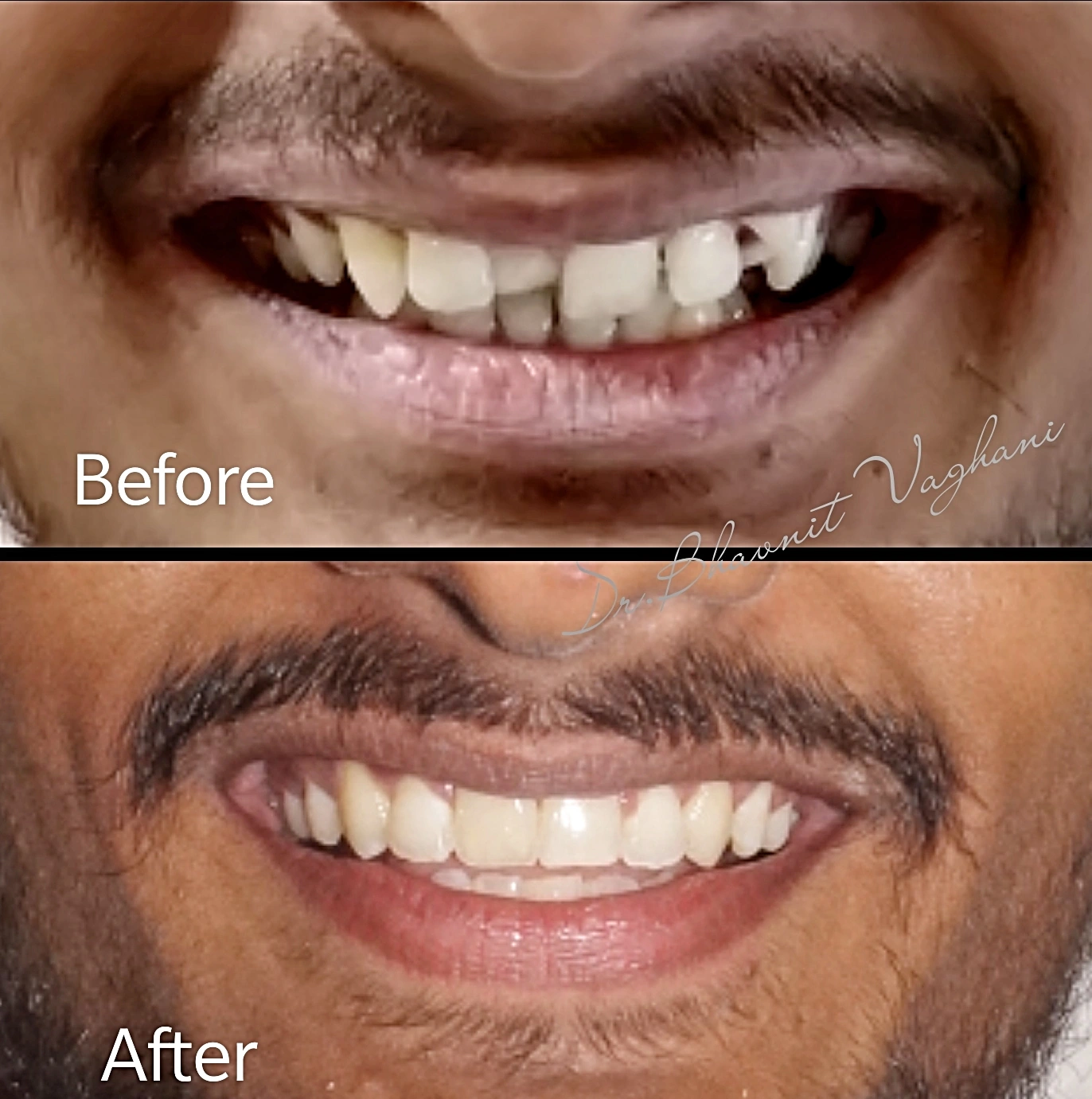 Impacted Teeth Traction - Before & After
