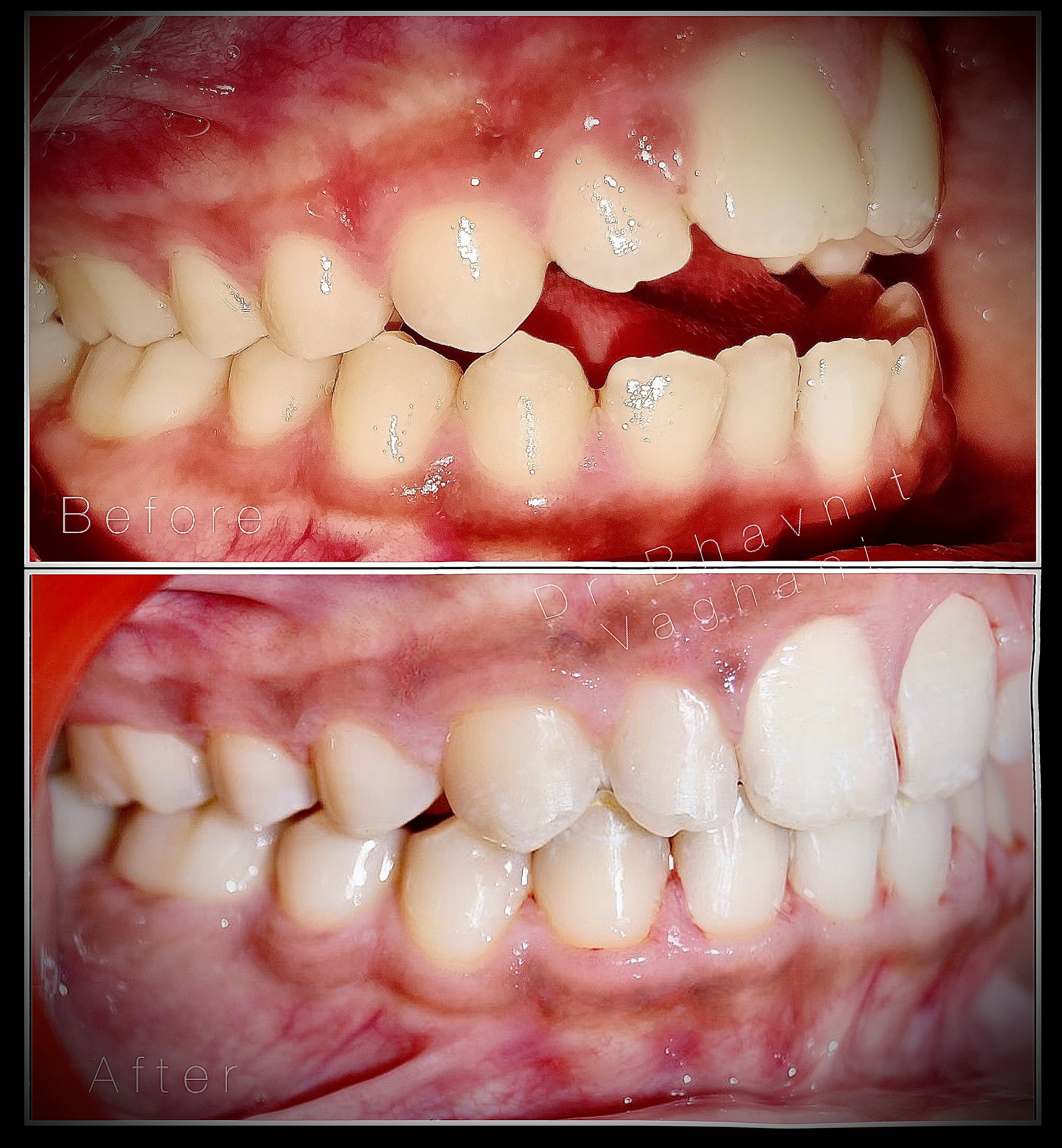 Anterior Open Bite Correction - Before & After