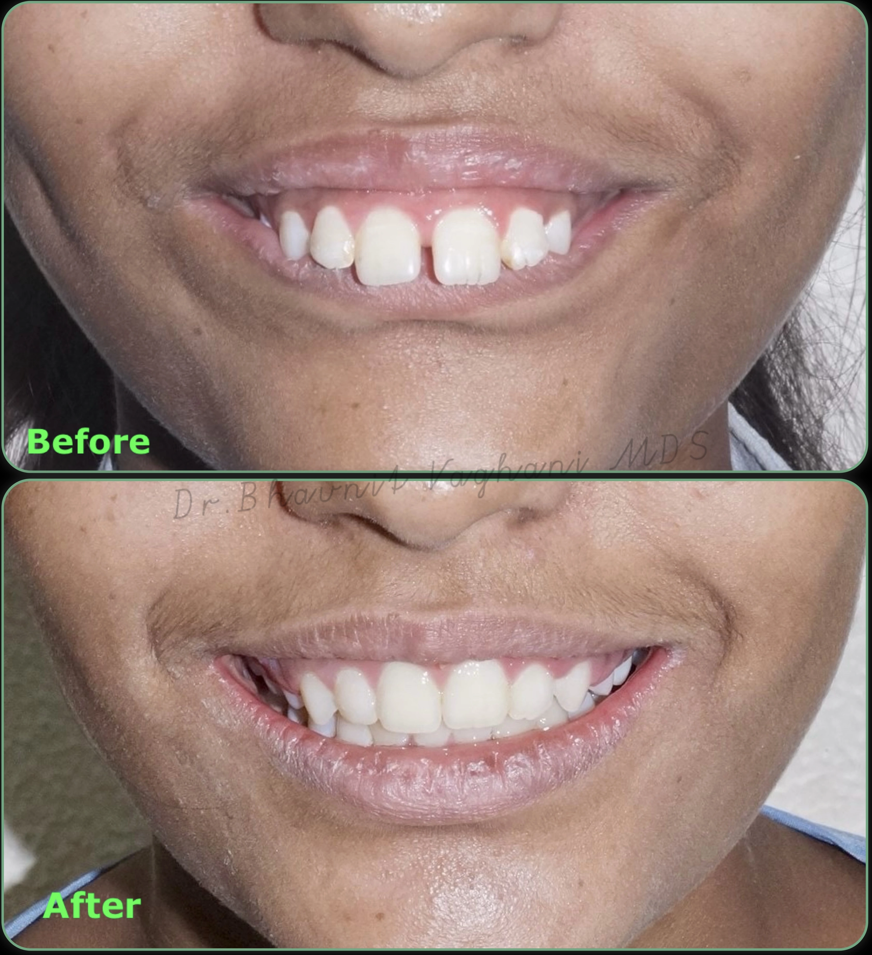 Protruding Teeth Retraction - Before & After