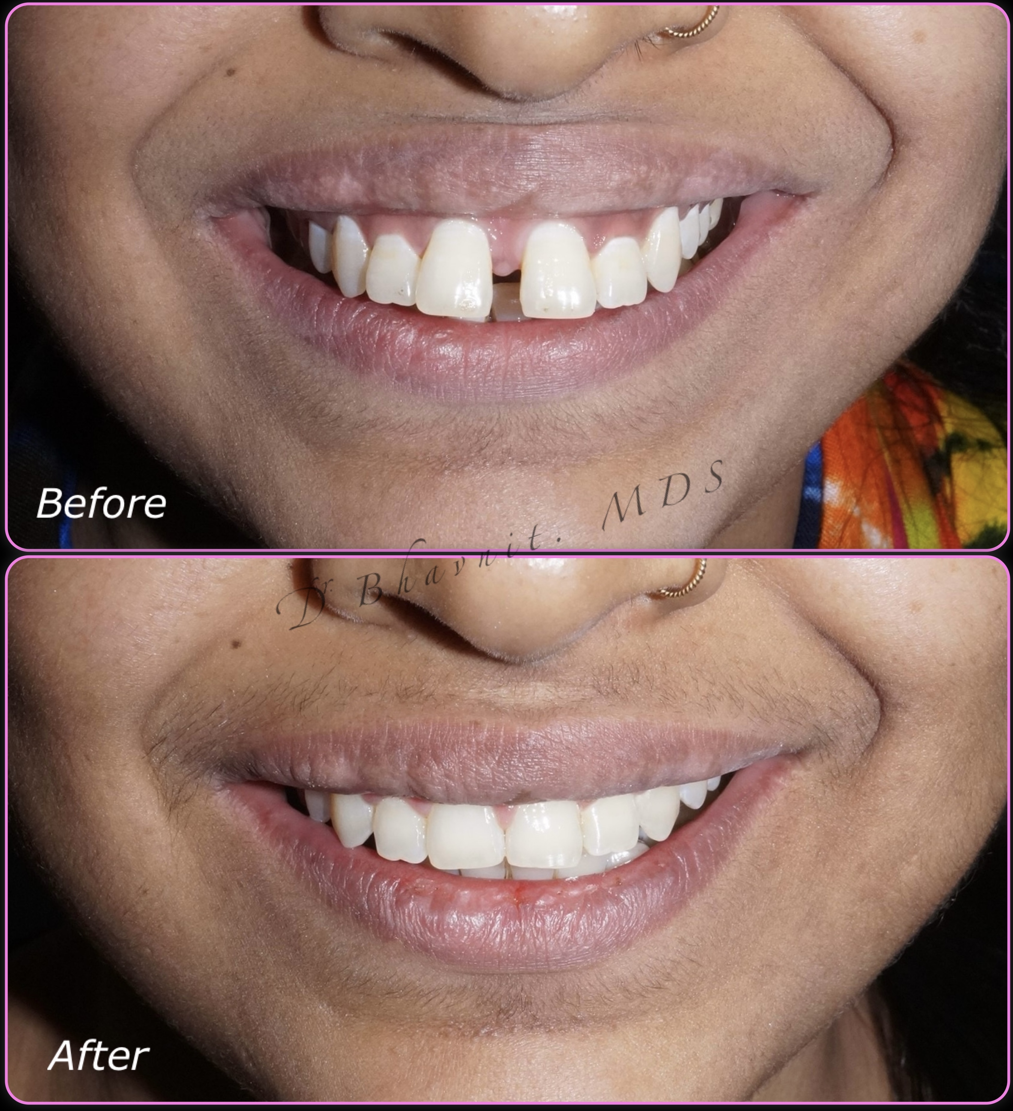 Adult Multi-Gap Correction - Before & After