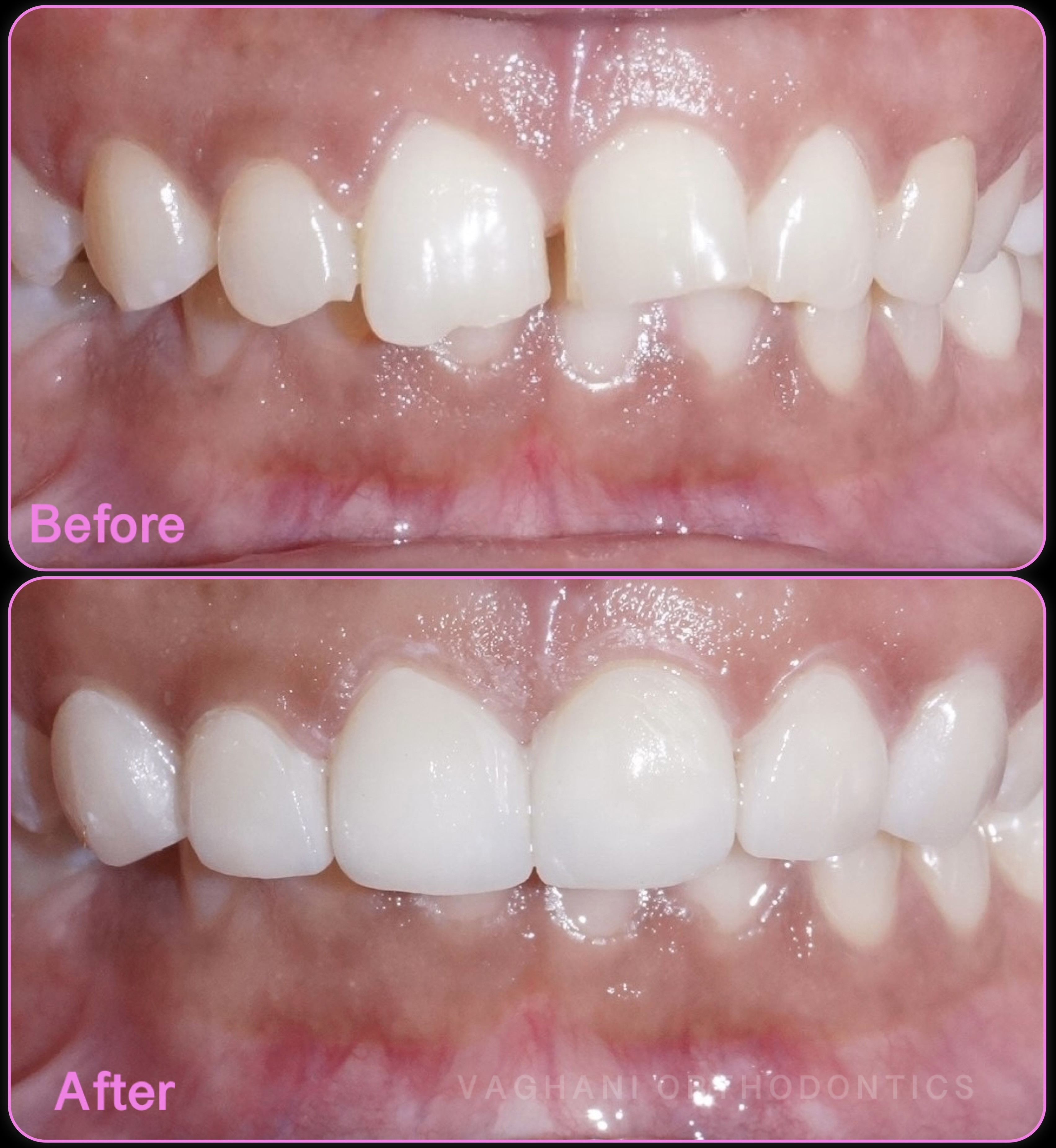 Broken Teeth Cosmetic Bonding - Before & After