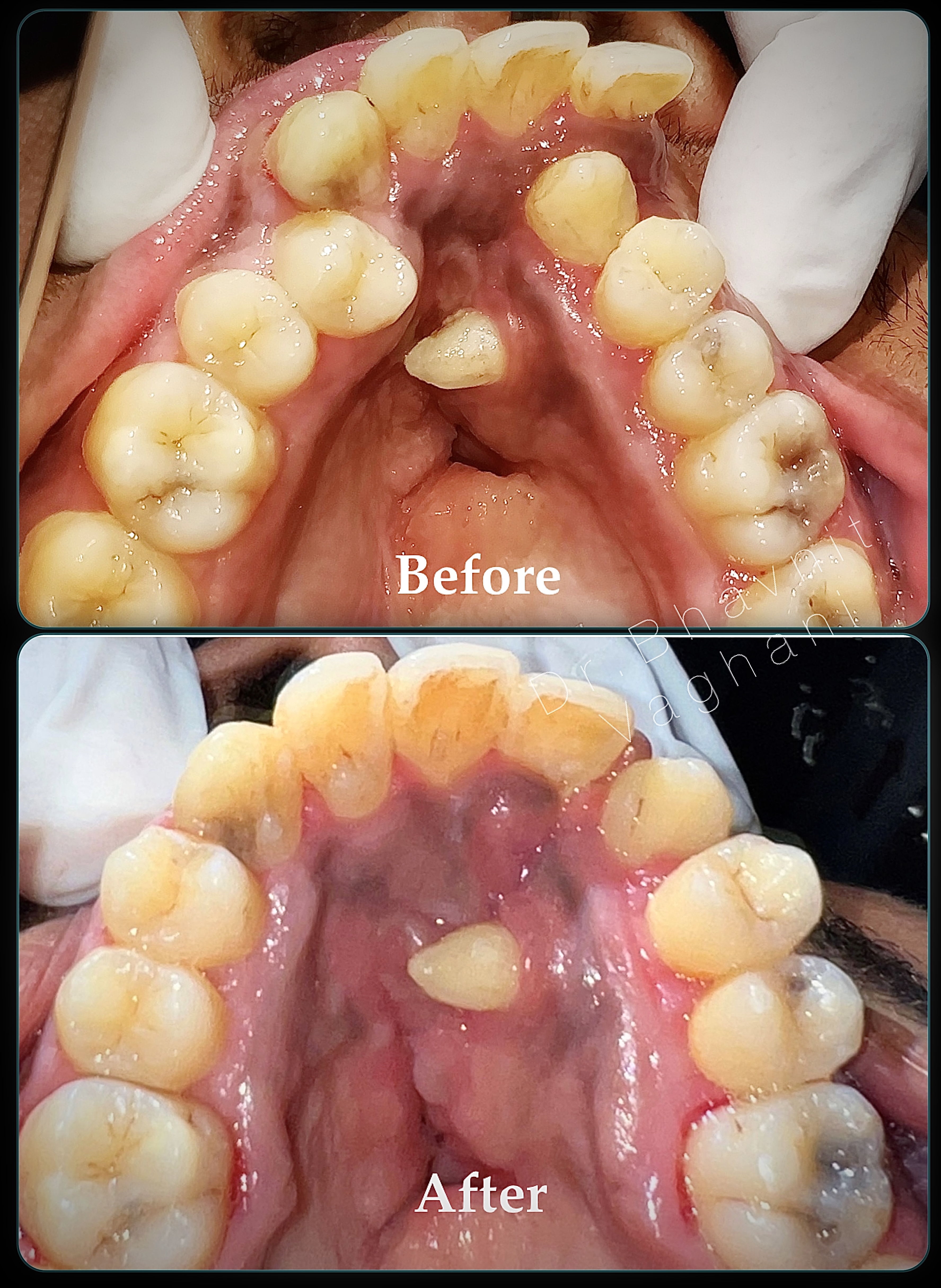 Cleft Palate & Palatal Expansion - Before & After