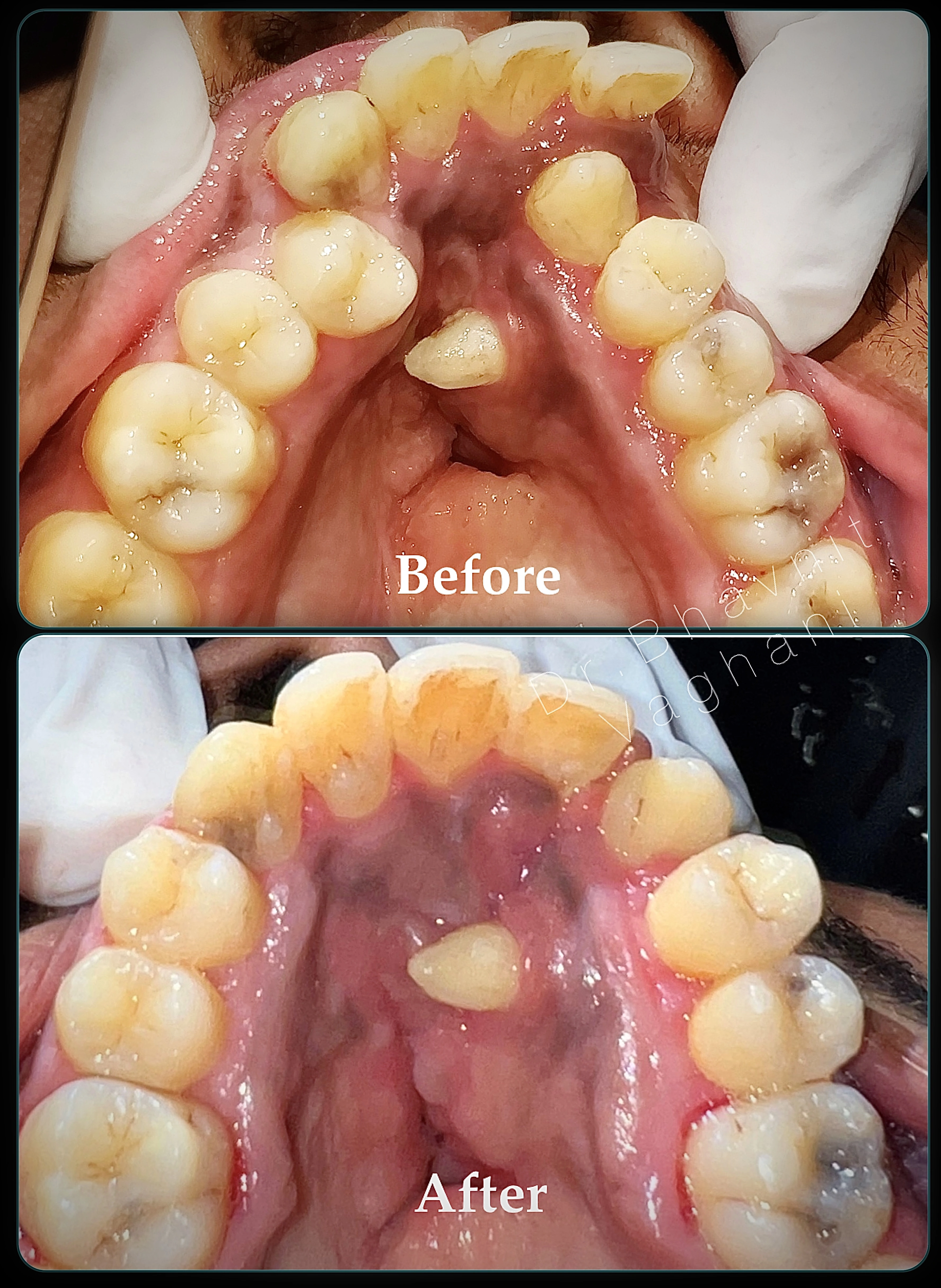 Cleft Palate & Palatal Expansion - Before & After
