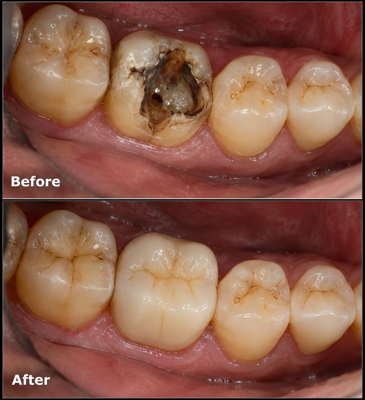 Deep Decay RCT & Ceramic Crown - Before & After