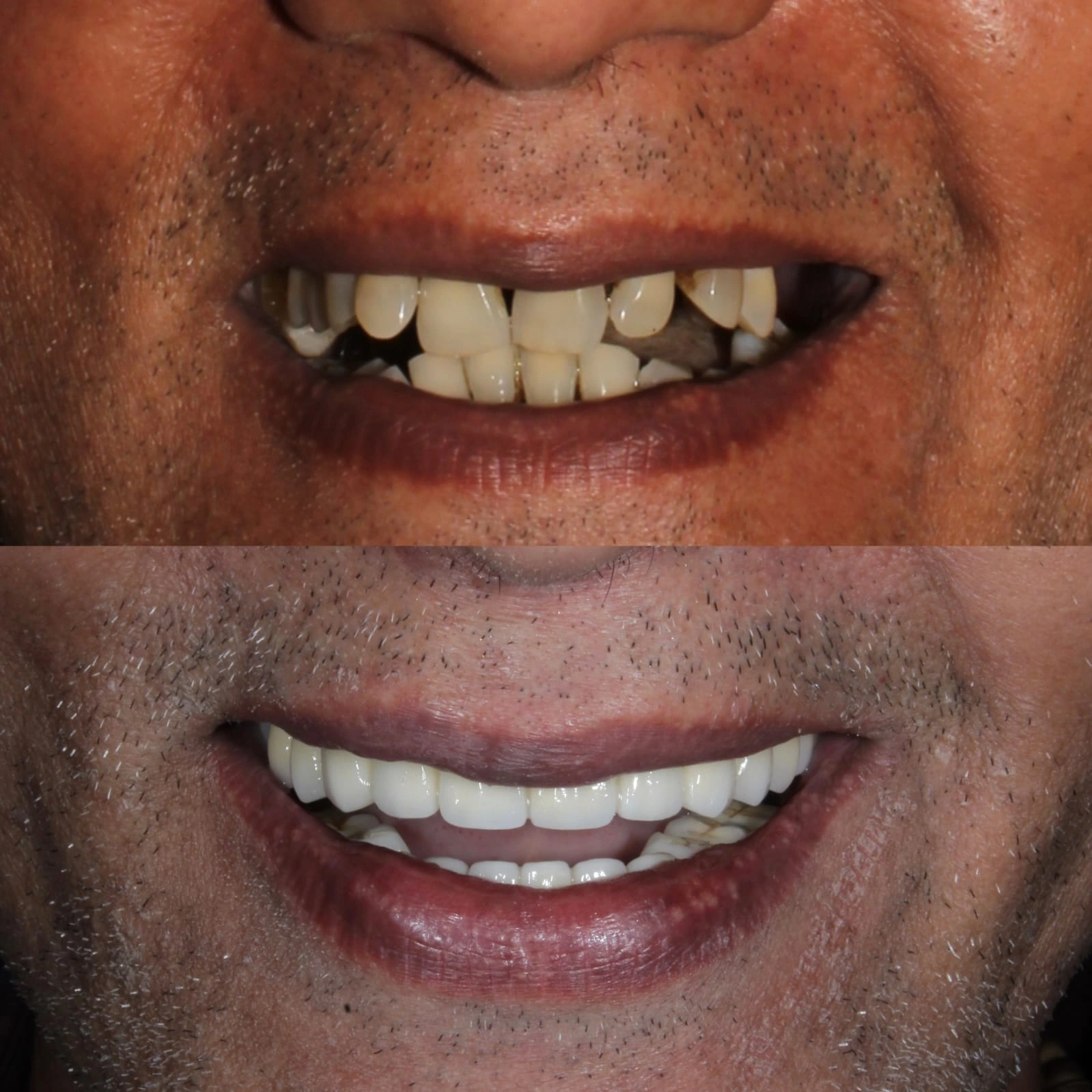 Full Mouth All-on-6 Rehabilitation - Before & After