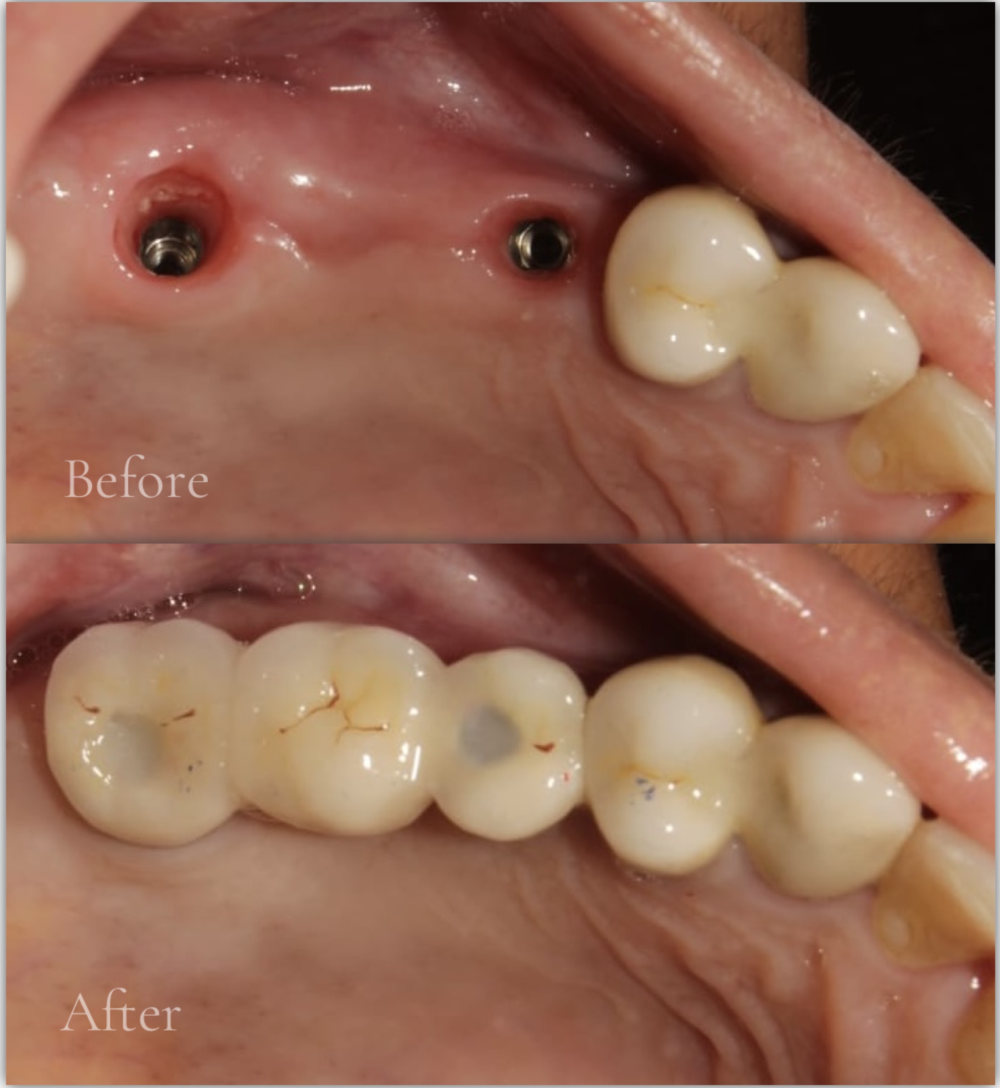 Multiple Missing Teeth Implants - Before & After
