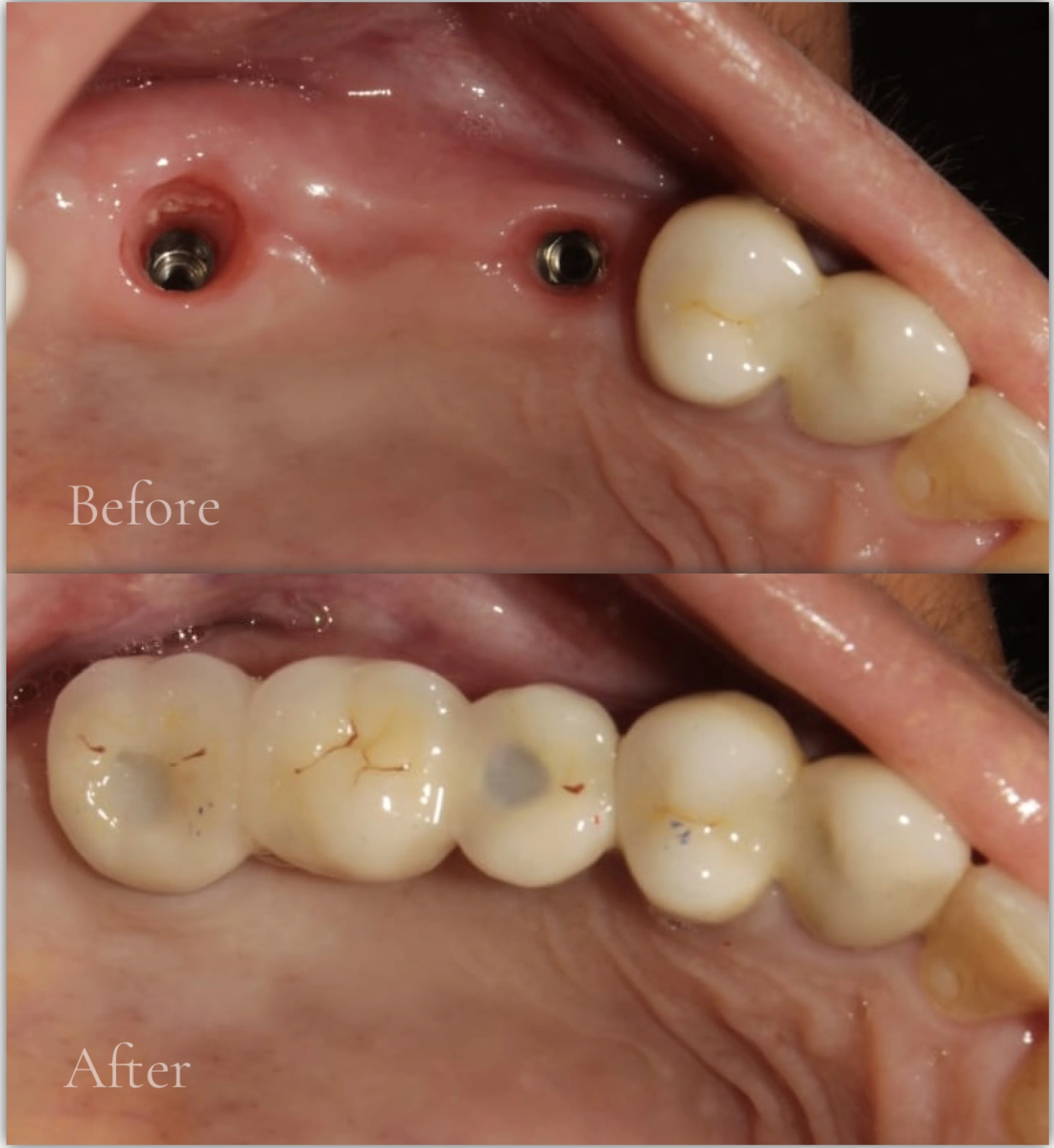 Multiple Missing Teeth Implants - Before & After