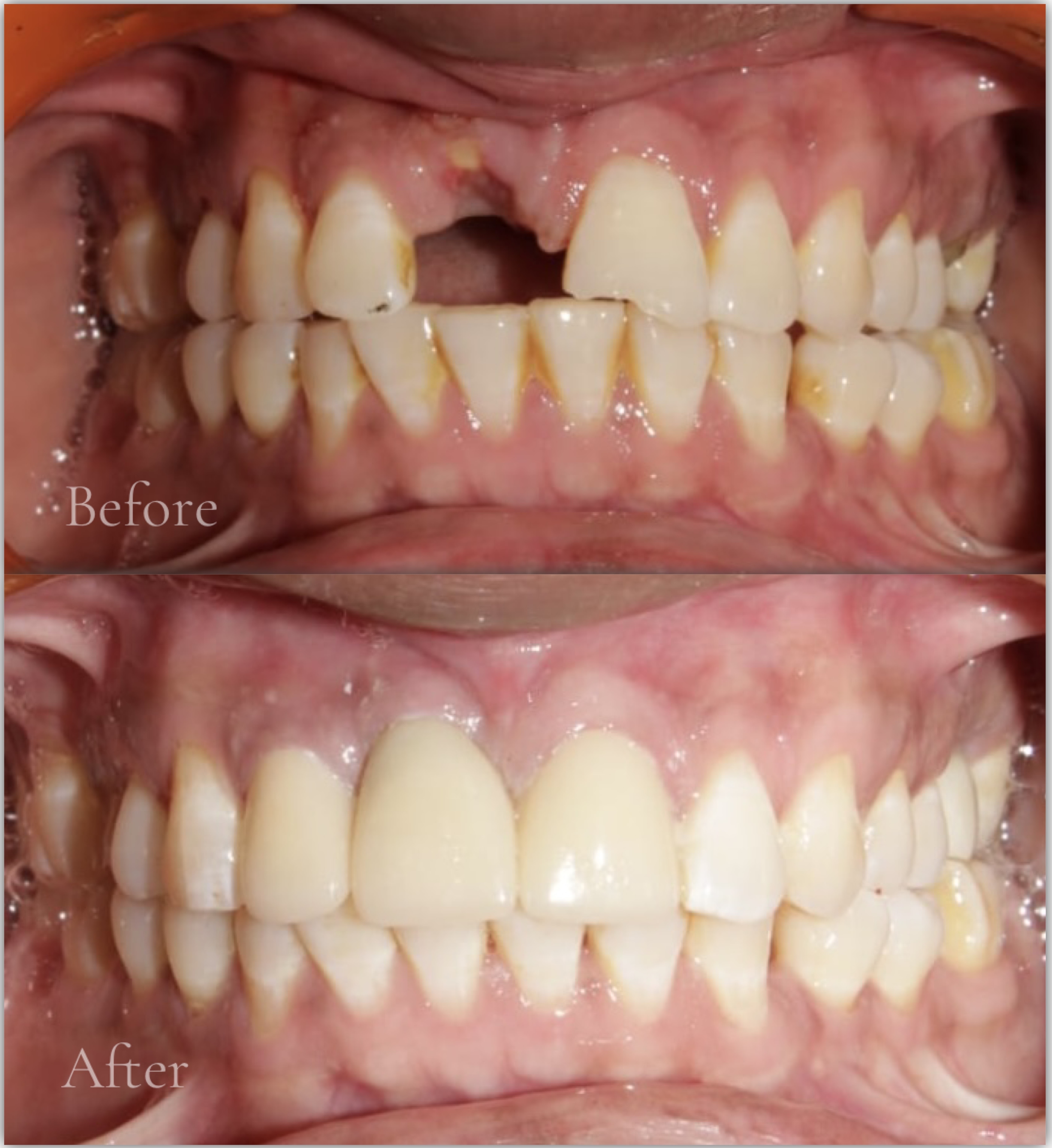 Single Missing Front Tooth - Before & After