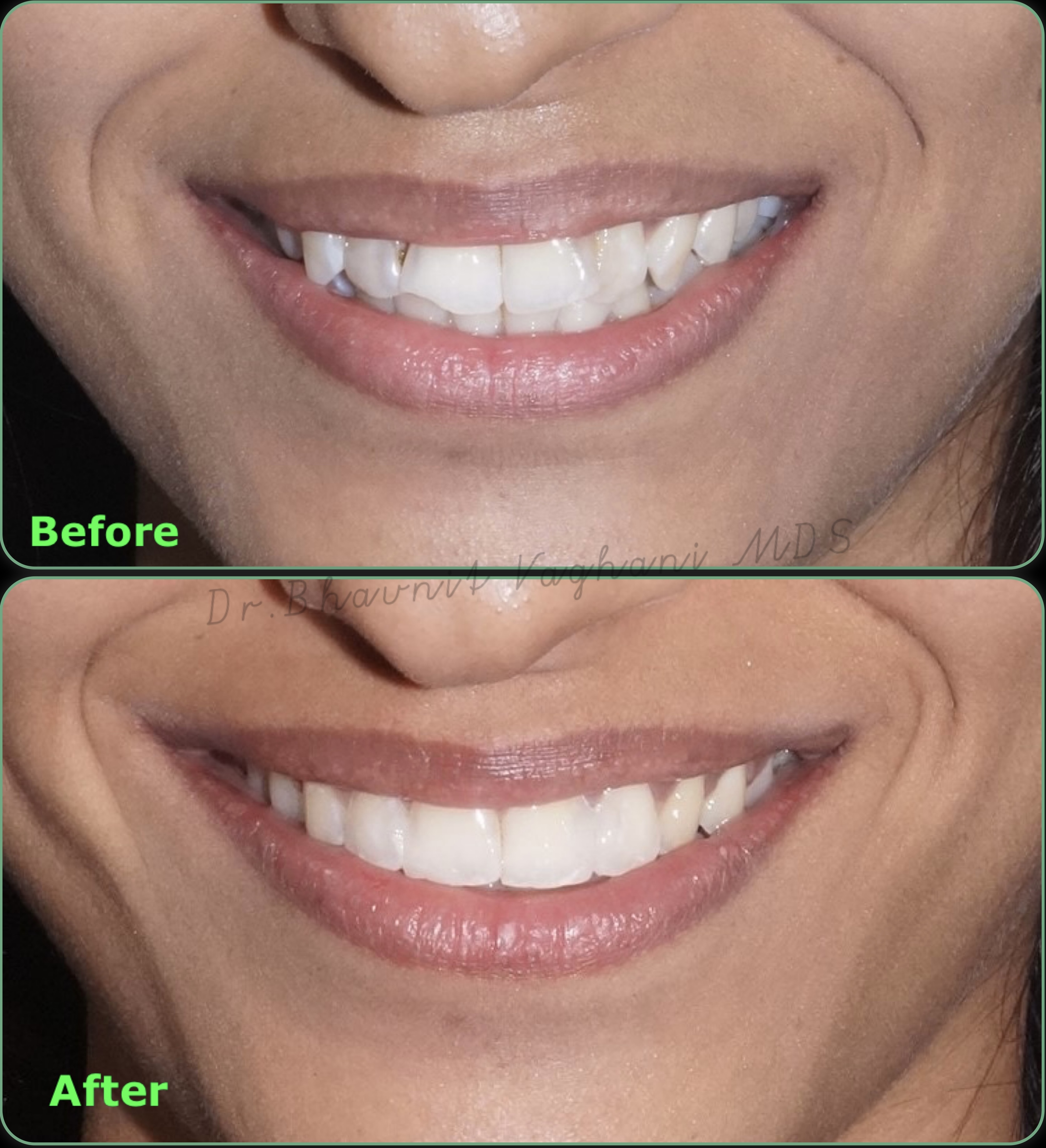 Decayed Front Tooth Restoration - Before & After