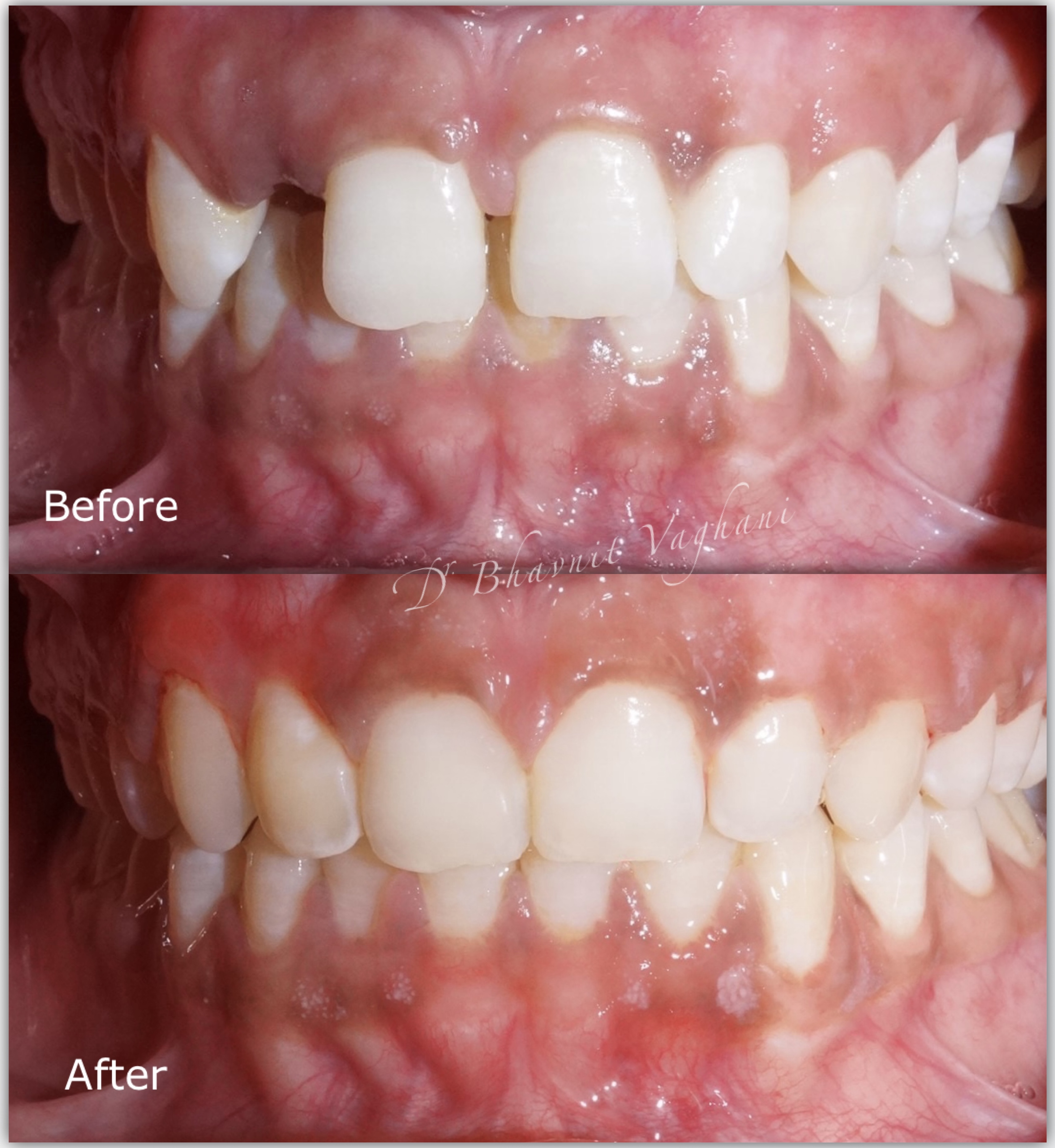 Gaping & Missing Teeth Makeover - Before & After