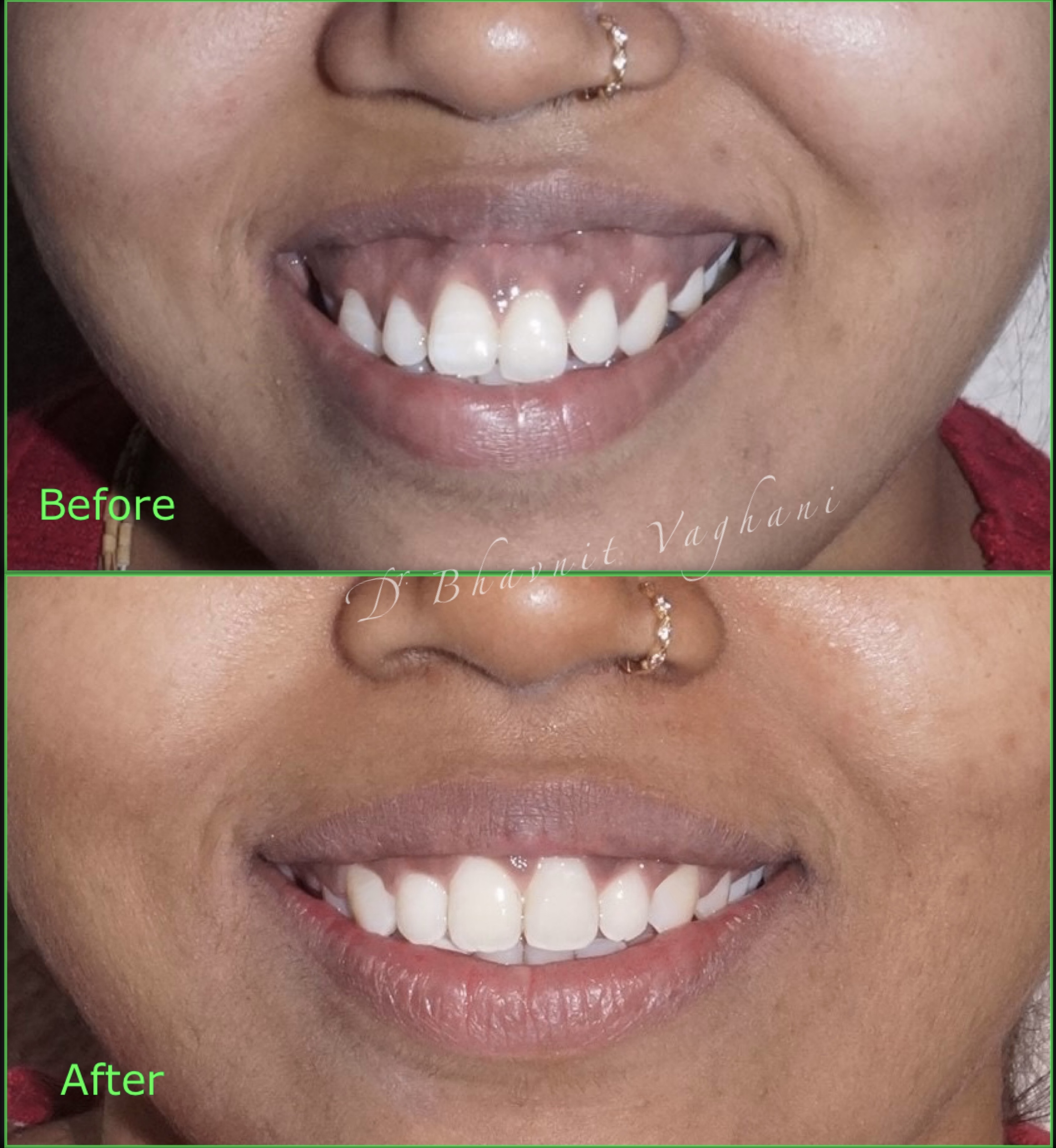 Gummy Smile & Gum Contouring - Before & After