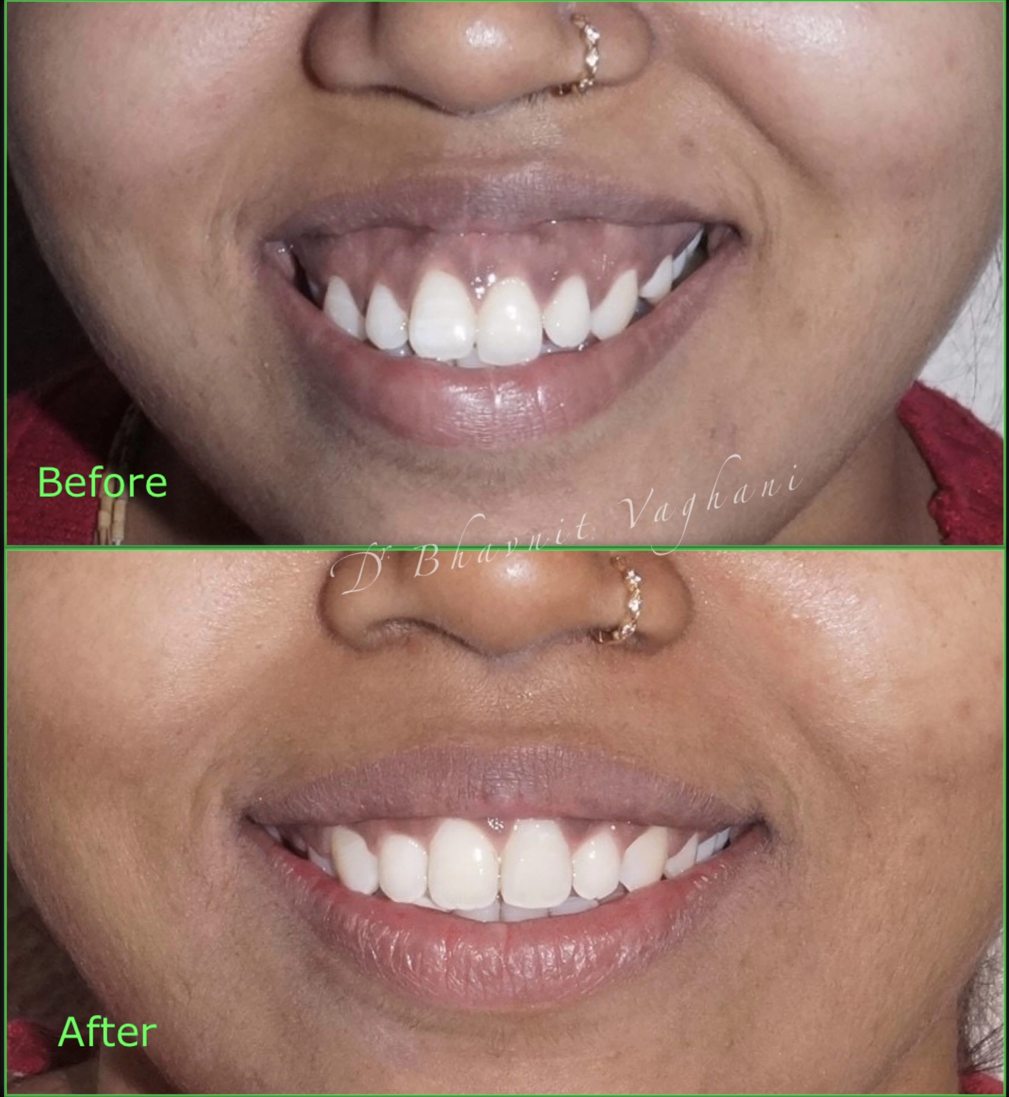 Gummy Smile & Gum Contouring - Before & After