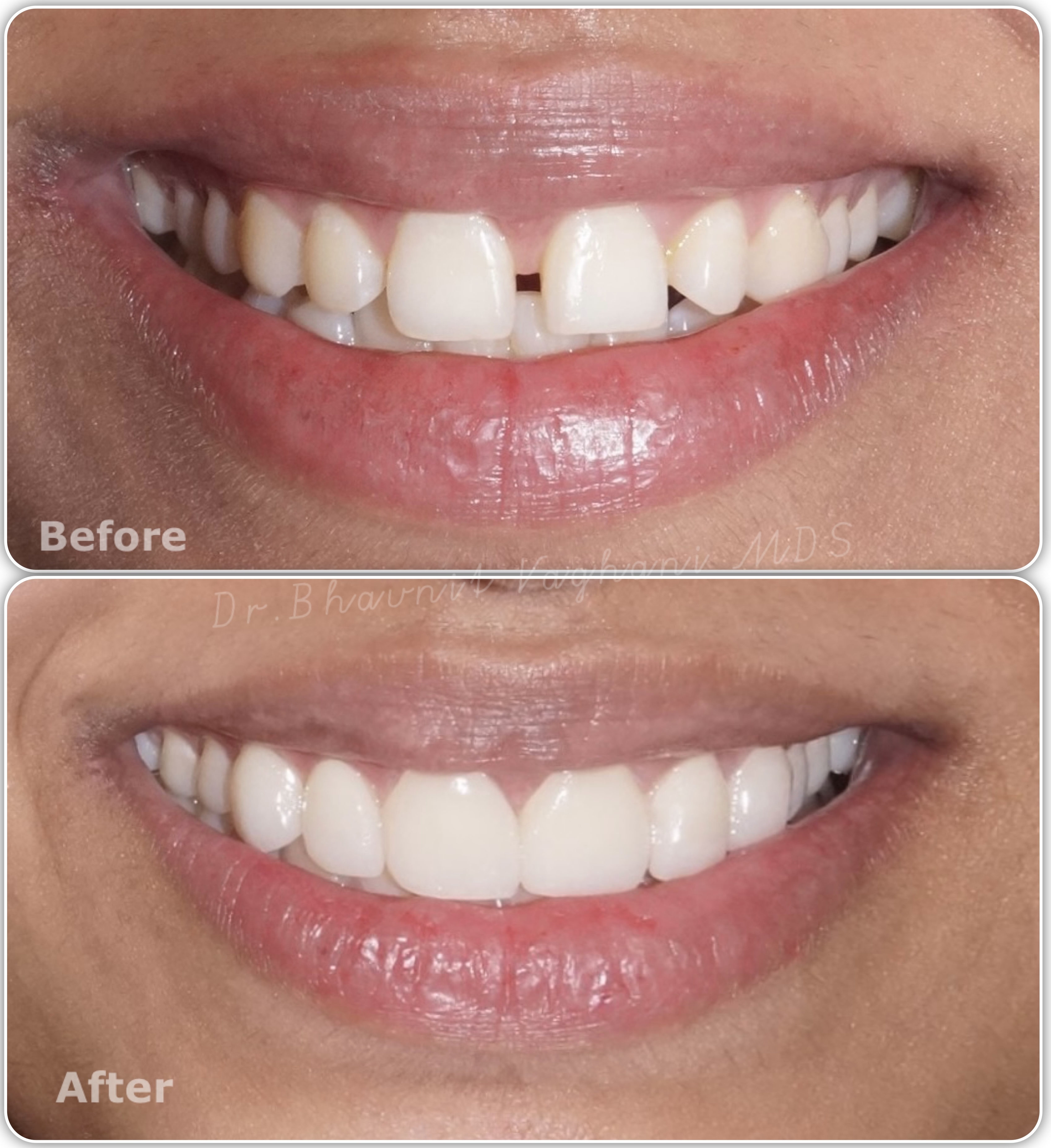 Porcelain Veneers for Gap Closure - Before & After