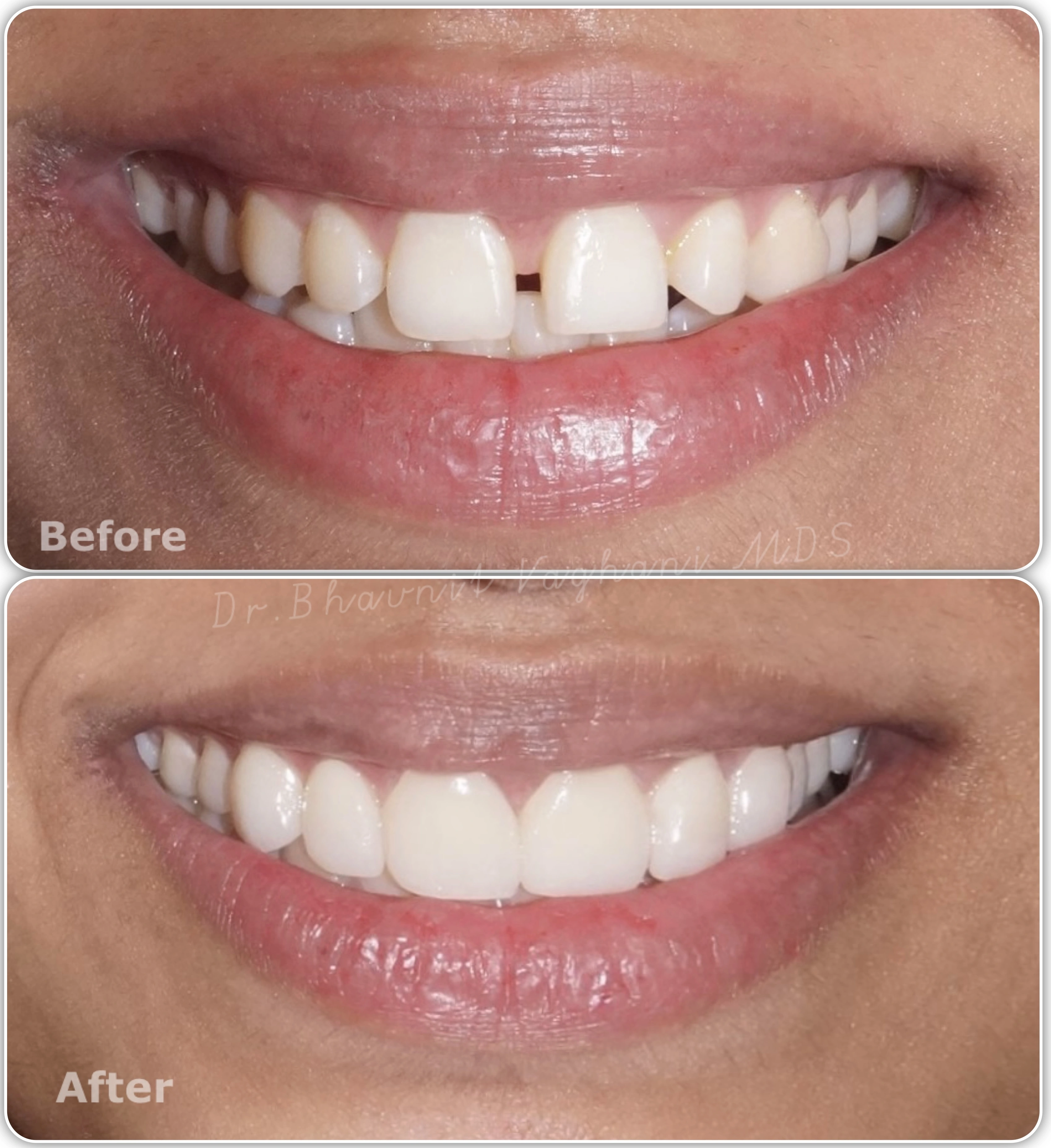 Porcelain Veneers for Gap Closure - Before & After