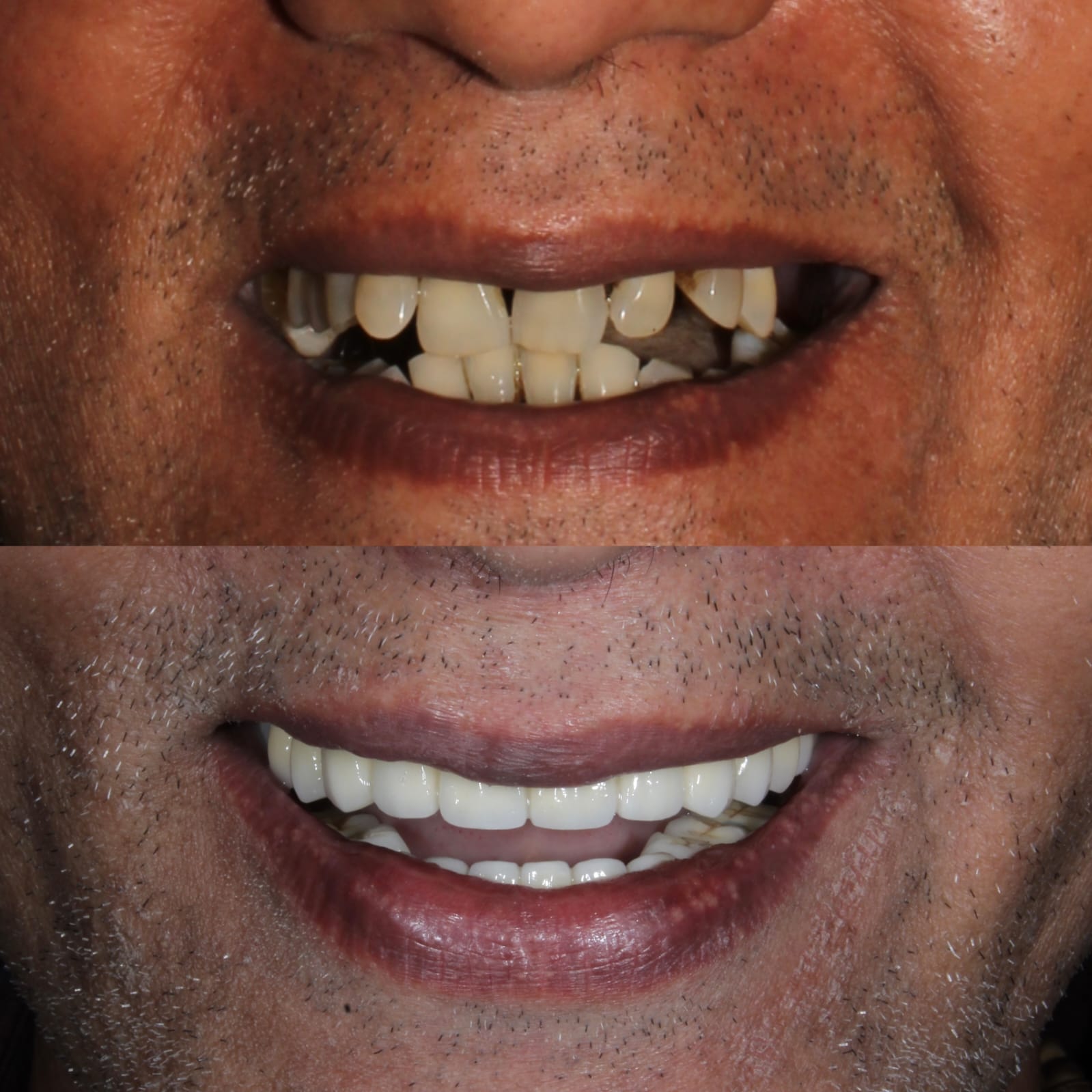 Full Mouth All on 6 Implants Before After