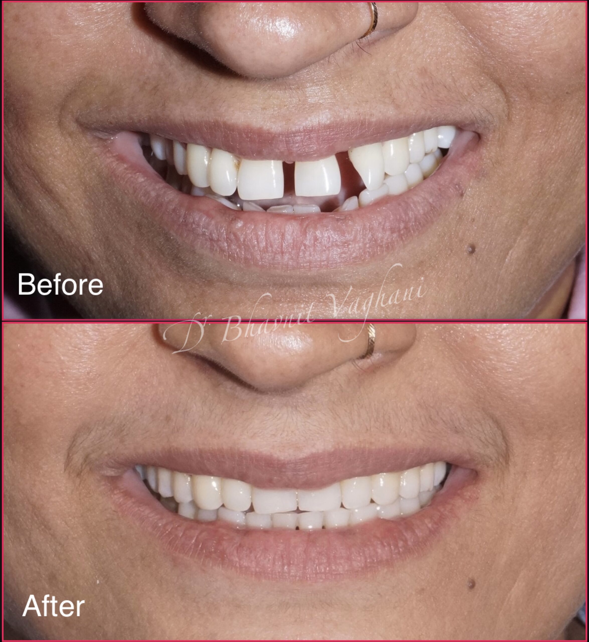 Aligner Spacing Case