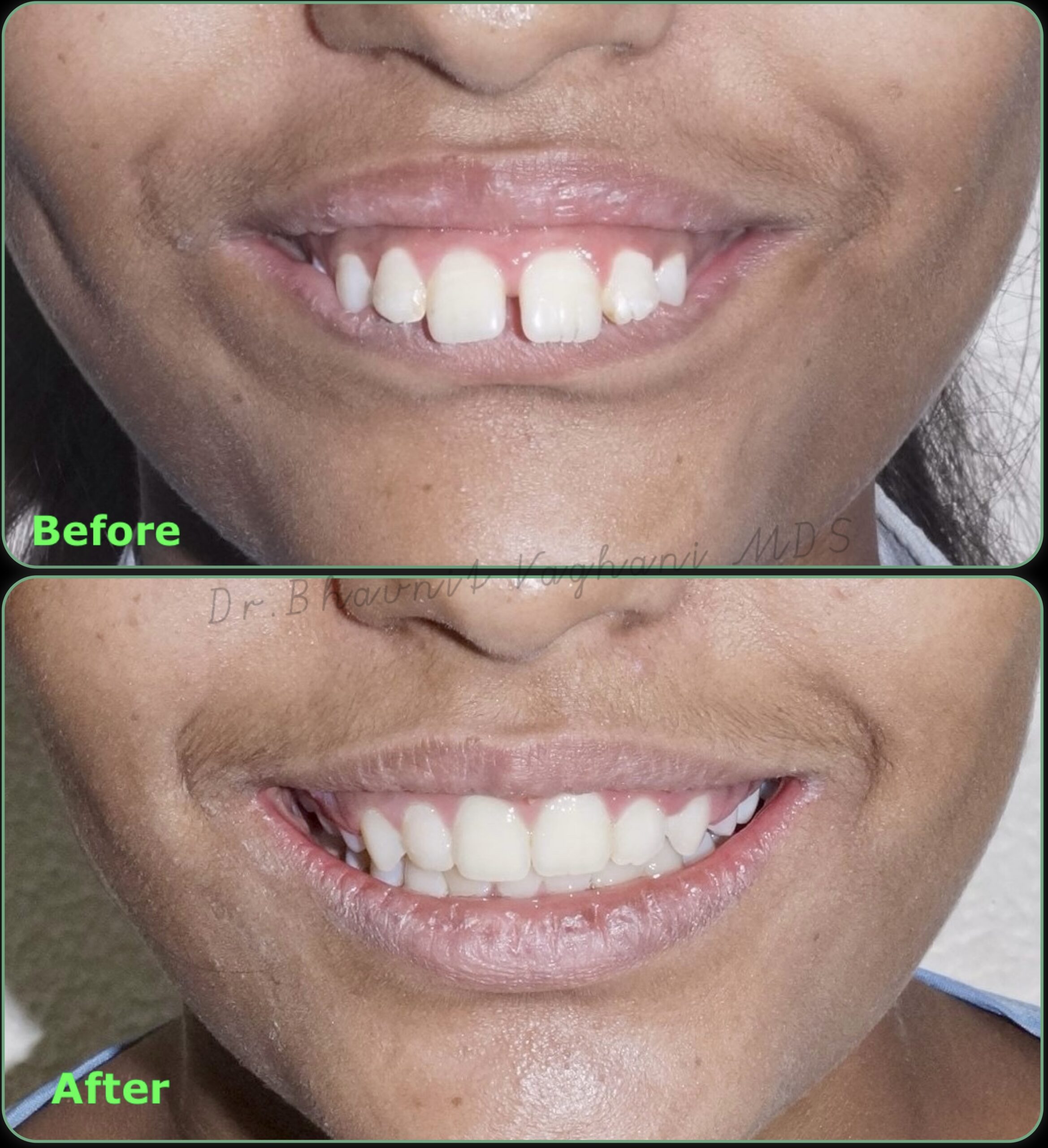 Protruding Teeth Transformation