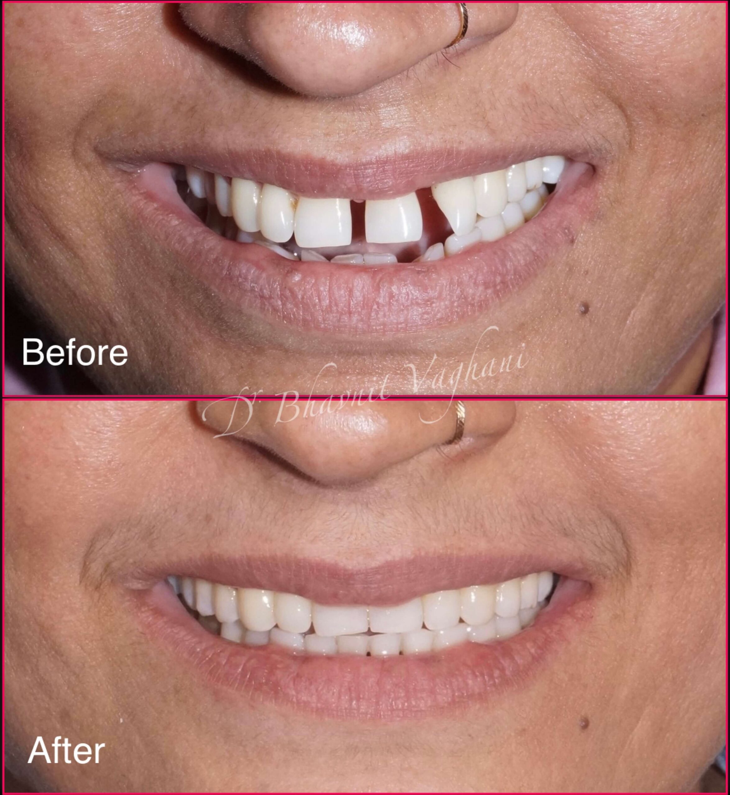 Aesthetic Smile Makeover Case 2