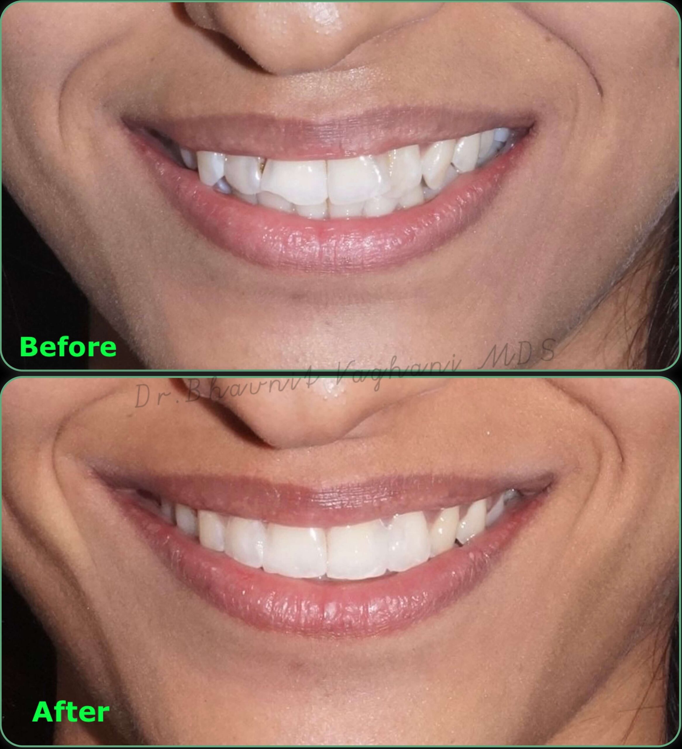 Aesthetic Smile Makeover Case 1