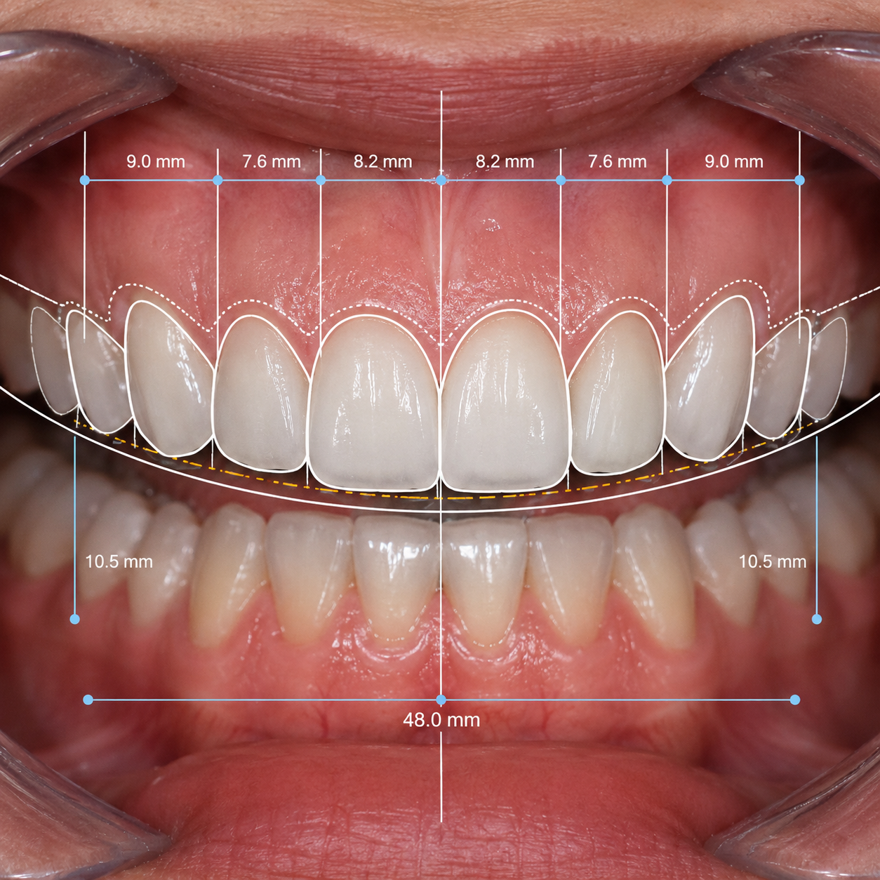 Smile Designing
