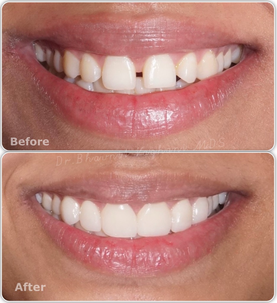 Gap Between Teeth Veneers - Age 32