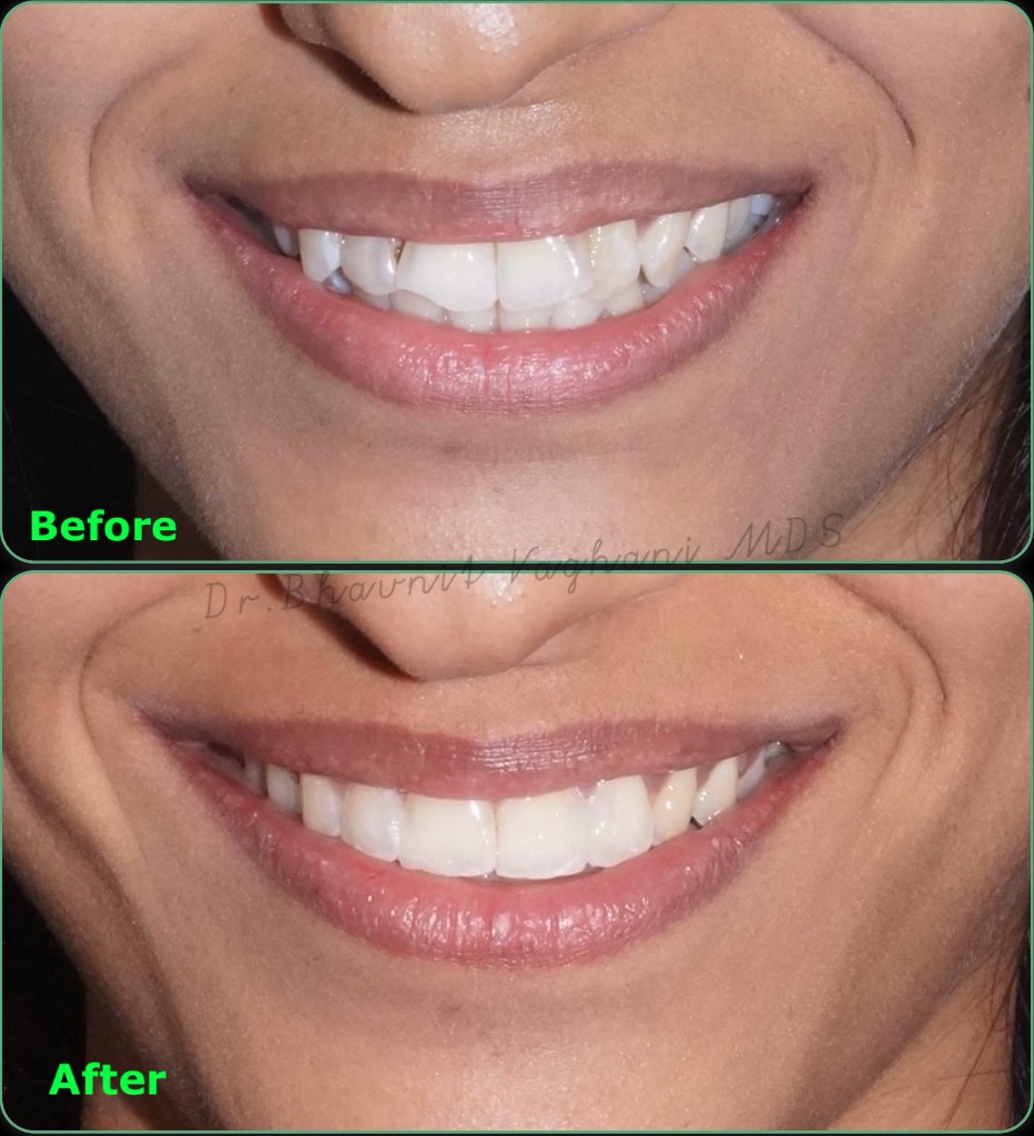 Decayed Front Tooth Composite Bonding - Age 21