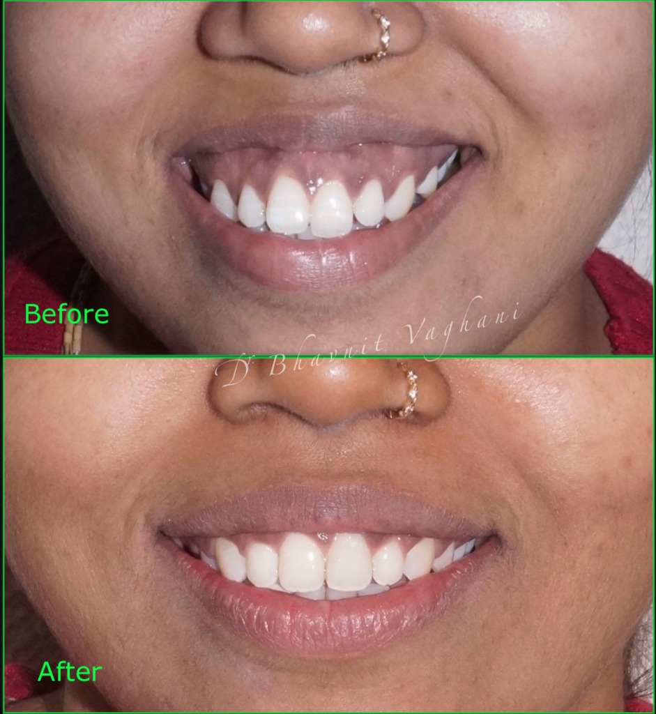 Gum Visibility Braces and Gum Contouring - Age 24