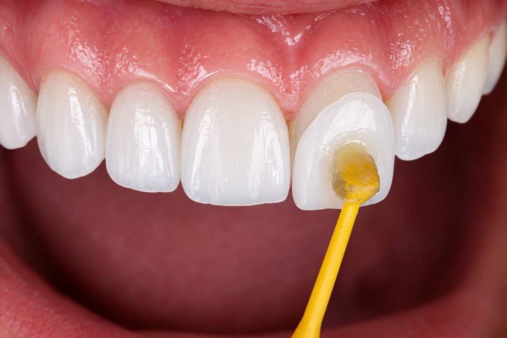 Porcelain Veneers